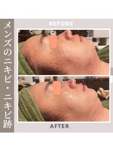 サロン ド R/■メンズのニキビケアもキレイに