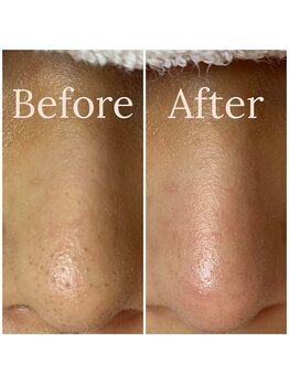 ウエカ(ueka)/黒ずみ毛穴目立っていませんか?