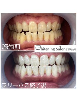 ホワイトニングサロン 京都烏丸店/ホワイトニング施術例