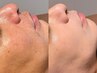 【脱毛】お試し！眠れるヒゲ脱毛＋モテ肌メンズフェイシャル　16500