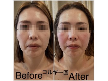 ケイビューティーサロン(K BeautySalon)/リガメント小顔コルギ