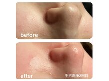 【毛穴洗浄】ずっと悩んでいた黒ずみから解放！