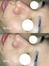 アルティ 福岡大名店(ARTI,)/メンズフェイシャル