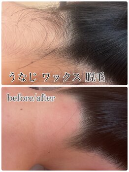 グルーミー(gloomy)/夏場人気！うなじの脱毛☆