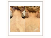 ラベニール(La Benir)/夏に人気のうなじ脱毛