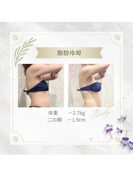 アディッシモ(addissimo)/脂肪冷却で二の腕ほっそり☆