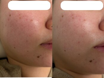 ルポナ(Reposna)/ビフォーアフター