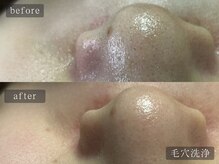 アムールサロン(Amour salon)/ハイドラ/毛穴洗浄/四谷三丁目