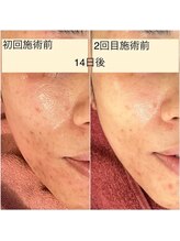 ルミラポー(Lumira Peau)/シミ集中ケア＋肌質改善