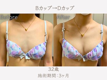 ハリスタ 梅田院(HARISTA)/3ヶ月間でBカップ→Dカップ