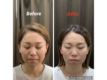 鍼灸チャンドラ(鍼灸Chandra)/女優鍼