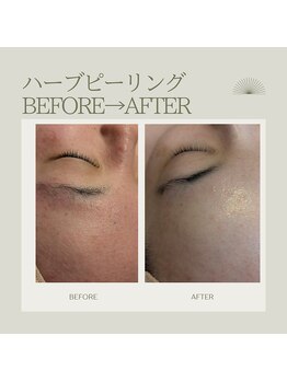 ミジタク 京都二条店(mijitaku)/ハーブピーリング5回目のお肌