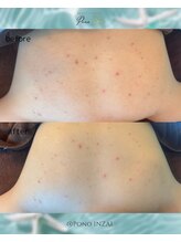 ポノ(Pono)/一度の施術効果☆