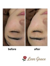 ラブグレイス(Lovegrace)/光フェイシャル