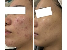 ハクビューティー(HAKU BEAUTY)/我慢はいらない