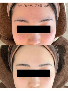 ボタニック 福津店(BoTANiC)/【ハーブピーリング】7回/20代