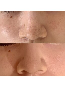 ナヴィータ アオバダイ(Navita AOBADAI)の写真/【毛穴レスな肌へ】話題の吸引洗浄ソフトピーリング＋エンビロンビタミン導入で黒ずみ・角栓・開き毛穴改善