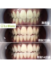 ルブラン 奈良店(Le Blanc)/回数重ねるとどんどん白く！