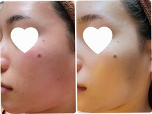 ムー ブランチ(Mou Branch)/ハーブトリートメント