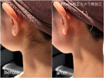 ブロートーキョー 有楽町店(BroTokyo)/襟足脱毛ぇ後ろ姿を綺麗に