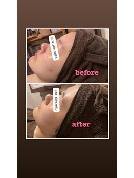 雅菜(miyabina)/ハーブテント＋ハーブピーリング