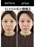 ☆初回人気No.1☆総合歪みリンパ小顔矯正¥29,700→¥11,000
