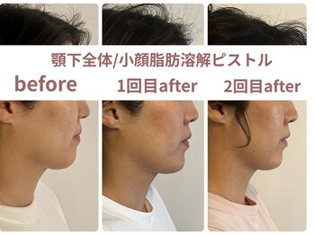 サボラミ(sabor A Mi)/顎下全体/小顔溶解ピストル