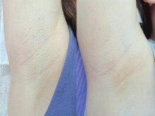 脇脱毛でスッキリ☆ムレなどの対策として男性にも人気です