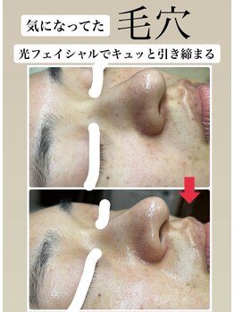 顔凛(カオリン)/毛穴もキュッと改善