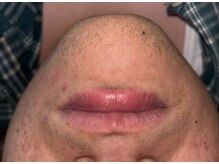 ベルフィオーレ(bel fiore)/20代男性　初回