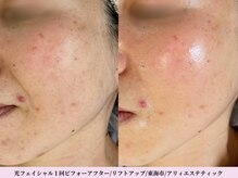 アリィ エステティック(allie esthetic)の雰囲気（光フェイシャル１回でハリ・ツヤのあるすっきりしたお顔に）