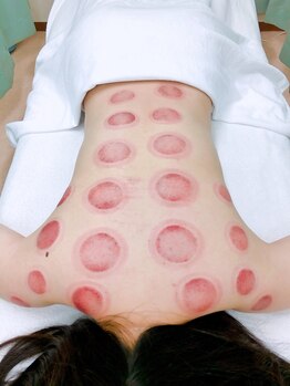 たくみ整体院/吸い玉