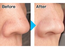 ディーキャットリー(D Catrry)/ハイドロピーリング毛穴洗浄