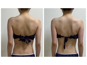 エヌラボ(N.LABO)/肩甲骨はがし