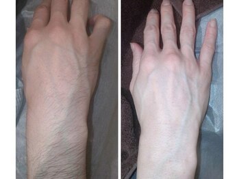 アンドユクス 国分寺(&uks)/メンズ脱毛/ひじ下/ビフォアフ