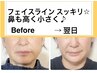 【小顔矯正】たるみ改善・口横のポニョっと集中引き上げ！