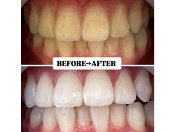 ホワイトニングサロン 豊中/Before&After美白ホワイトニング