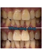ホワイトニングショップ 武蔵小杉店/【BeforeAfter】2回 施術後比較