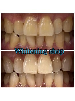 ホワイトニングショップ 武蔵小杉店/【BeforeAfter】2回 施術後比較