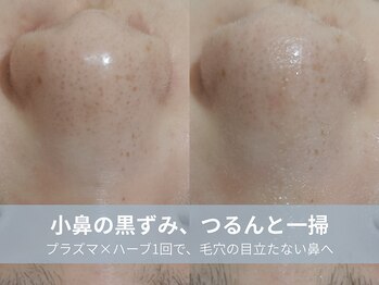 ラシック 加古川店(La chic.)/頑固な角栓・ざらつきを徹底ケア