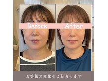 ルフレ(Reflet)の雰囲気（口腔内から整える新感覚小顔オーラルエステ/施術３回目）