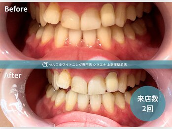 セルフホワイトニング専門店 シマエナ上新庄駅前店/2回でしっかり白く