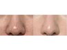 【医◯クリニッ◯レベル】毛穴の凹凸・肌荒れ気になる部分集中ケア0.8cc
