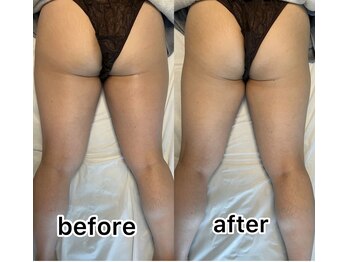 キノ(Kino)/セルライトゼロ★