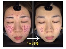 ユララ(YURARA)/肌の奥まで見える！？肌診断機♪