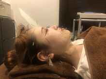 ロミハリ(LomiHari)/美容鍼