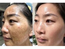 癒える(ielu)/圧倒的★ダイヤモンドピール