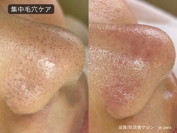 ジュパール(je pars)/毛穴エクストラクション