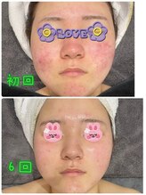 ケーフリー(K-free)/ハーブピーリング