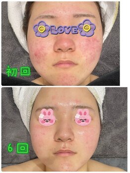 ケーフリー(K-free)/ハーブピーリング